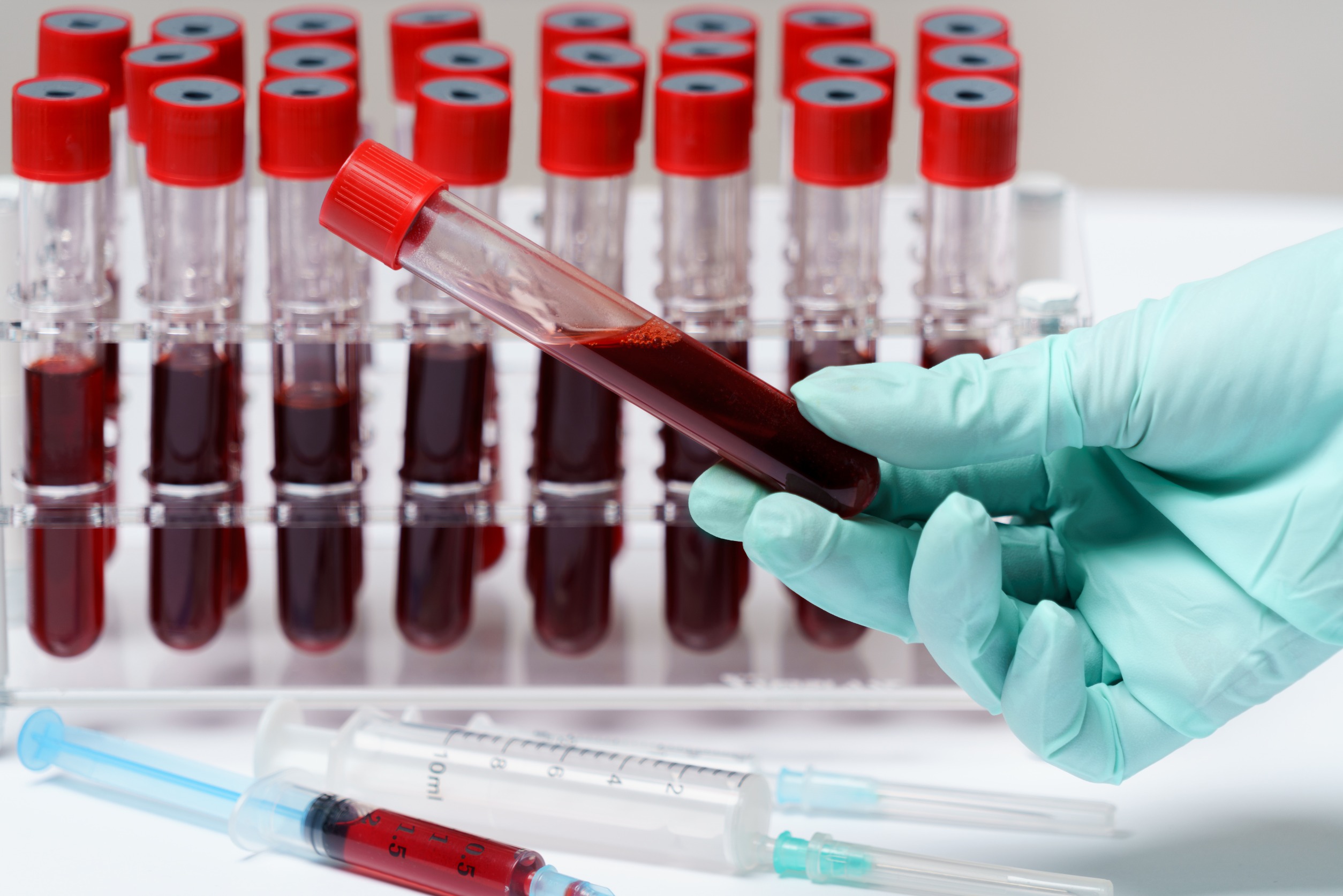 Analityk medyczny trzyma w dłoni fiolkę z krwią pobraną pacjentowi, aby poddać ją diagnostyce. /Źródło: 123rf.com
