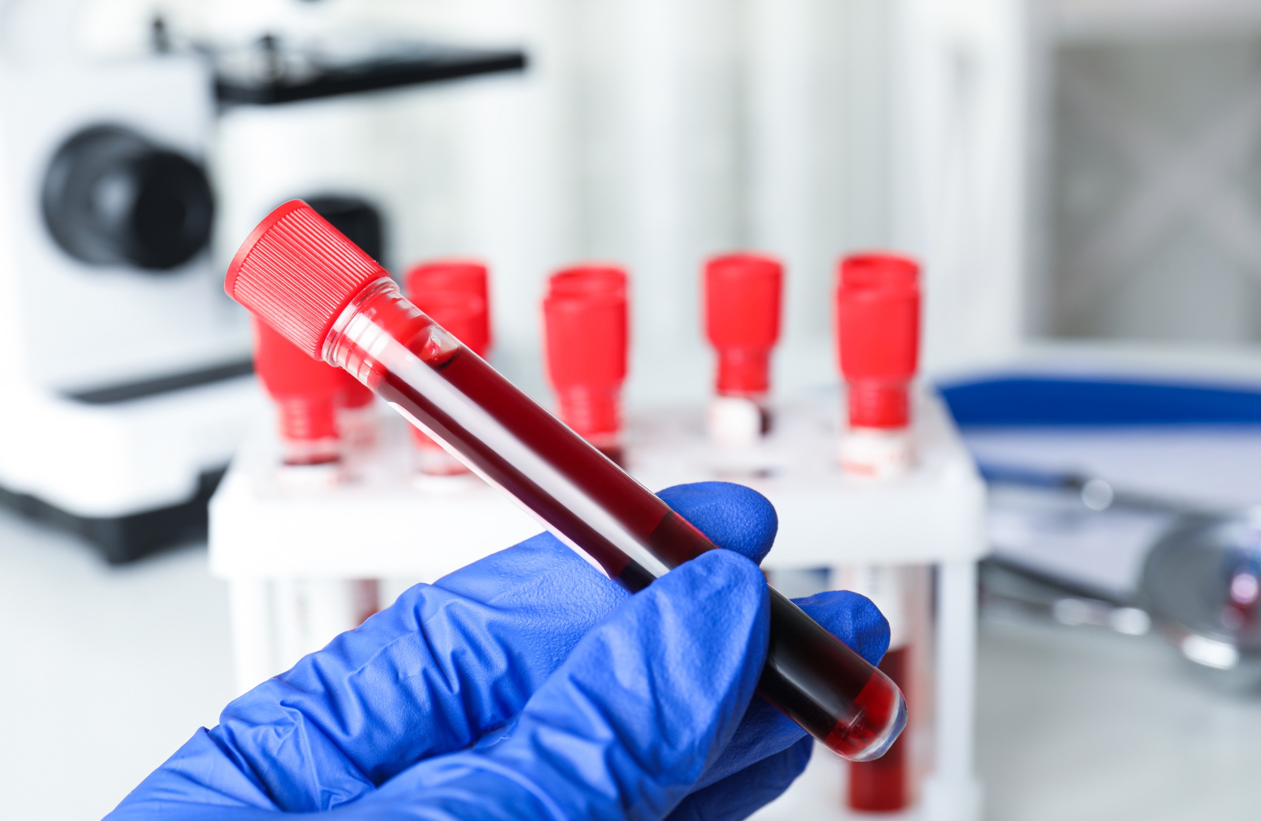 Analityk laboratoryjny ma w dłoni fiolkę wypełnioną krwią pacjenta. /Źródło: 123rf.com