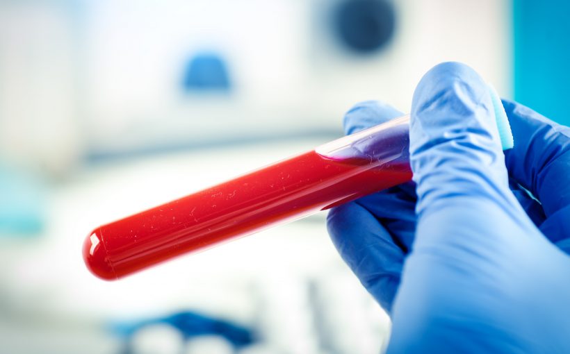 Diagnosta laboratoryjny trzyma w dłoni odzianej w sterylną rękawiczkę, probówkę wypełnioną jasnoczerwoną, wyrazistą krwią. /Źródło: 123rf.com