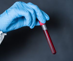 Analityk medyczny trzyma w dłoni odzianej w sterylną rękawiczkę fiolkę z próbką krwi pobraną pacjentowi, aby poddać ją diagnostyce laboratoryjnej. /Źródło: 123rf.com