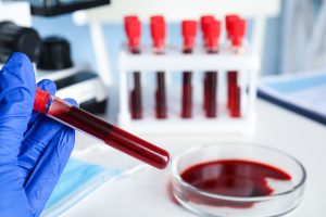 Technik laboratoryjny poddaje analizie próbkę krwi pacjenta. /Źródło: 123rf.com