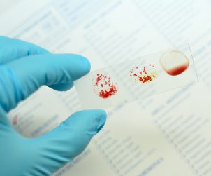 Analityk laboratoryjny trzyma w dłoni szkiełko z kroplami krwi, w celu określenia grupy krwi. /Źródło: 123rf.com