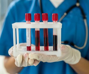 Pielęgniarka w niebieskim, medycznym stroju ze stetoskopem na szyi trzyma w dłoni cztery probówki z krwią pobraną do badań laboratoryjnych. /Źródło: 123rf.com