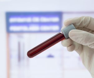Pielęgniarka po pobraniu krwi trzyma w dłoni probówkę aby sprawdzić czy nie wytworzył się skrzep. /Źródło: 123rf.com