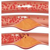 cholesterol_LDL_HDL_lipidogram_profil_lipidowy_Bydgoszcz_Toruń_Elbląg_Lublin_Łódź_Gorzów_Kołobrzeg