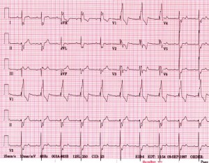 ekg kraków,ekg z opisem kraków, elektrokardiografia