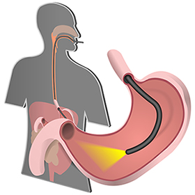gastroskopia nowy sącz, pracownia gastroskopii, pracownia endoskopii, pracownia endoskopowa, badanie gastroskopi , gastrolog, gastroenterolog