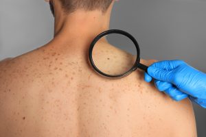 Lekarz dermatolog ogląda zmiany barwnikowe na ciele pacjenta, aby zdiagnozować ewentualne nowotwory skóry. /Źródło: 123rf.com