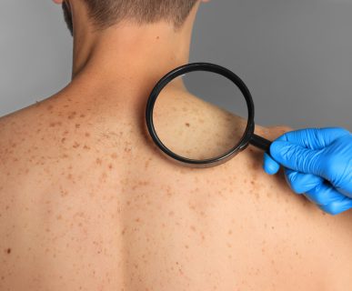 Lekarz dermatolog ogląda zmiany barwnikowe na ciele pacjenta, aby zdiagnozować ewentualne nowotwory skóry. /Źródło: 123rf.com