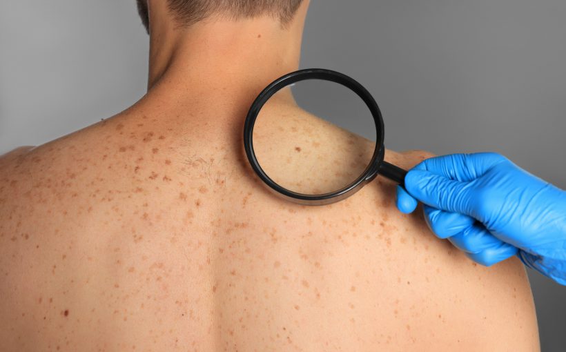 Lekarz dermatolog ogląda zmiany barwnikowe na ciele pacjenta, aby zdiagnozować ewentualne nowotwory skóry. /Źródło: 123rf.com