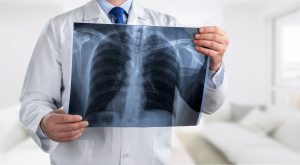 Lekarz specjalista radiolog trzyma w dłoni rentgen klatki piersiowej pacjenta. /Źródło: 123rf.com