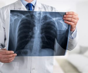 Lekarz specjalista radiolog trzyma w dłoni rentgen klatki piersiowej pacjenta. /Źródło: 123rf.com