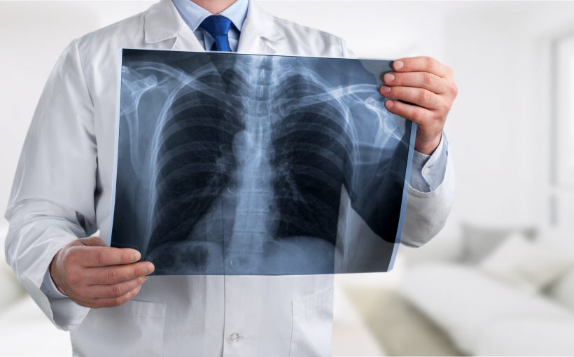 Lekarz specjalista radiolog trzyma w dłoni rentgen klatki piersiowej pacjenta. /Źródło: 123rf.com