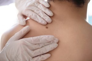 Lekarz dermatolog sprawdza czy znamię na plecach pacjenta jest groźne. /Źródło: 123rf.com