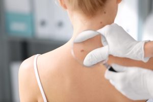 Lekarz dermatolog bada pacjentce znamiona barwnikowe na karku. /Źródło: 123rf.com