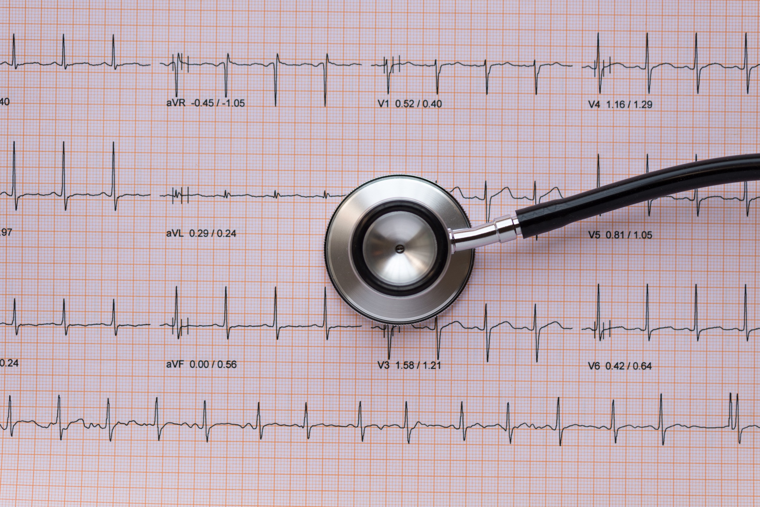 Stetoskop leży na wydrukowanym opisie EKG pacjenta. /Źródło: 123rf.com