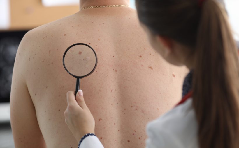 Lekarz dermatolog sprawdza zmiany na plecach pacjenta. /Źródło: 123rf.com