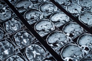 Zdjęcie przedstawiające wynik rezonansu głowy pacjenta, chorującego na schorzenie neurologiczne. /Źródło: 123rf.com