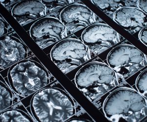 Zdjęcie przedstawiające wynik rezonansu głowy pacjenta, chorującego na schorzenie neurologiczne. /Źródło: 123rf.com