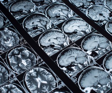 Zdjęcie przedstawiające wynik rezonansu głowy pacjenta, chorującego na schorzenie neurologiczne. /Źródło: 123rf.com