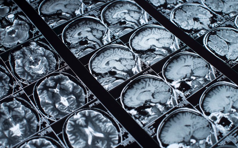 Zdjęcie przedstawiające wynik rezonansu głowy pacjenta, chorującego na schorzenie neurologiczne. /Źródło: 123rf.com