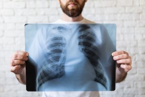 Mężczyzna trzyma w dłoniach wykonane wcześniej zdjęcie rentgenowskie klatki piersiowej. /Źródło: 123rf.com