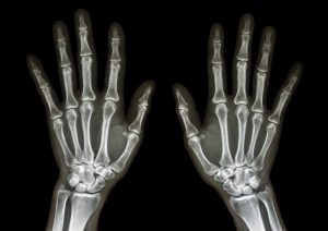 Fotografia przedstawiająca zdjęcie rentgenowskie obu dłoni. /Źródło: 123rf.com