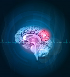 Grafika przedstawiająca udar mózgu u człowieka. /Źródło: 123rf.com