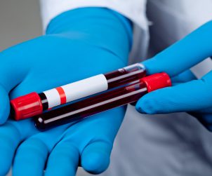 Asystent medyczny trzyma w dłoniach odzianych w niebieskie, sterylne rękawiczki, dwie fiolki z pobraną krwią pacjentów do diagnostyki laboratoryjnej. Źródło: 123rf.com