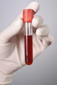 Pracownik laboratorium trzyma w dłoni odzianej w sterylną, białą rękawiczkę fiolkę z próbką krwi pacjenta do celów analizy oraz diagnostyki laboratoryjnej. Źródło: 123rf.com