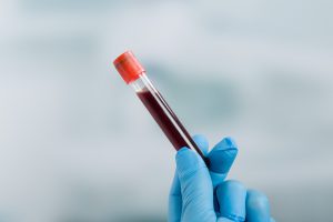 Pielęgniarz trzyma w dłoni odzianej w niebieską, sterylną rękawiczkę, fiolkę wcześniej pobranej krwi do celów diagnostycznych. /Źródło 123rf.com