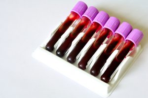 Sześć fiolek z różowymi nakrętkami z pobraną wcześniej krwią pacjentów do celów diagnostycznych. Źródło: 123rf.com