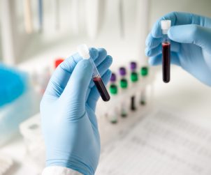 Pracownik medyczny w sterylnych rękawiczkach trzyma dwie fiolki z pobraną próbką krwi. Źródło: 123rf.com