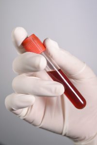 Osoba w rękawiczkach sterylnych trzyma w dłoni fiolkę z wcześniej pobraną krwią pacjenta do analizy laboratoryjnej.