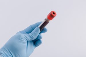 Pielęgniarz medyczny trzyma w dłoni odzianej w sterylną rękawiczkę próbkę krwi pacjenta.
