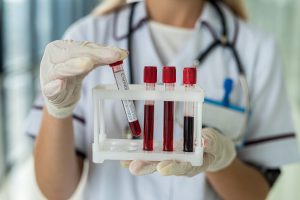Pielęgniarka w fartuchu stoi trzymając w dłoniach fiolki z pobraną krwią pacjenta w celu diagnostyki laboratoryjnej.