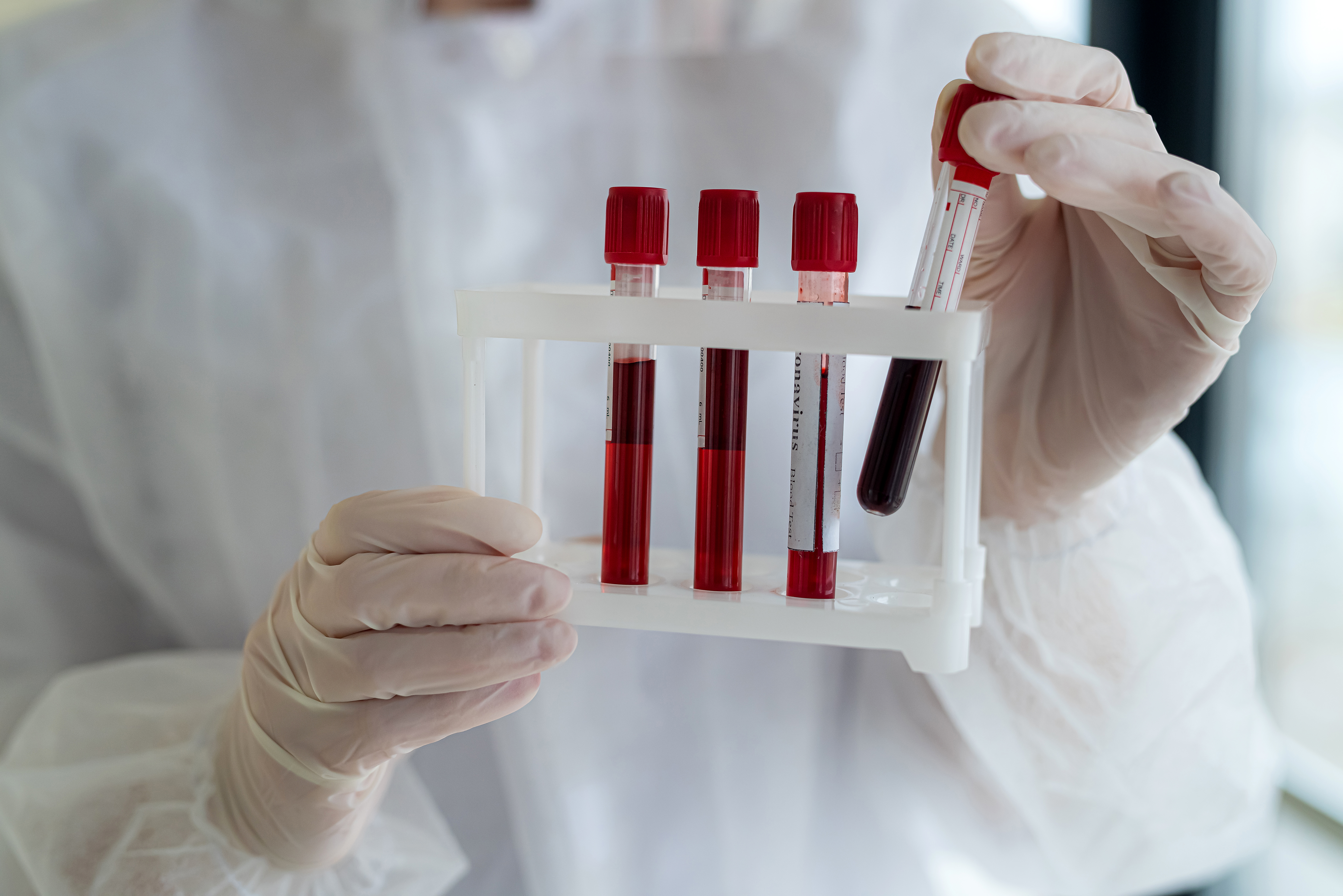 Closeup of doctor hands holding blood sample